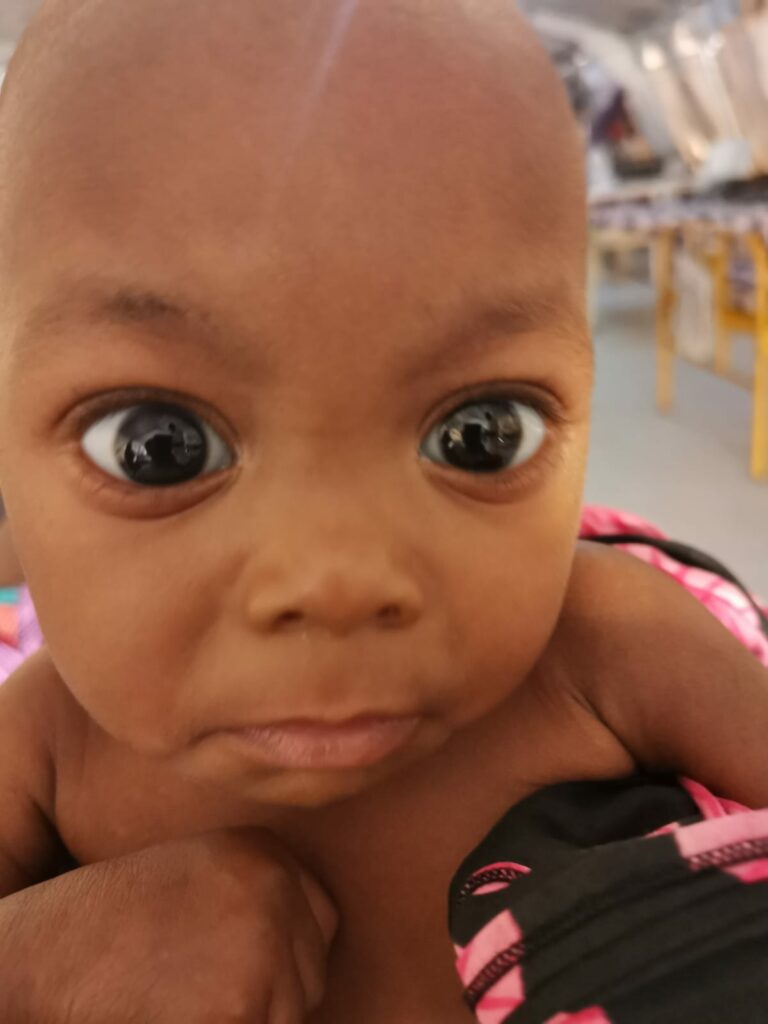 Underernæret baby hjulpet af Læger uden Grænser