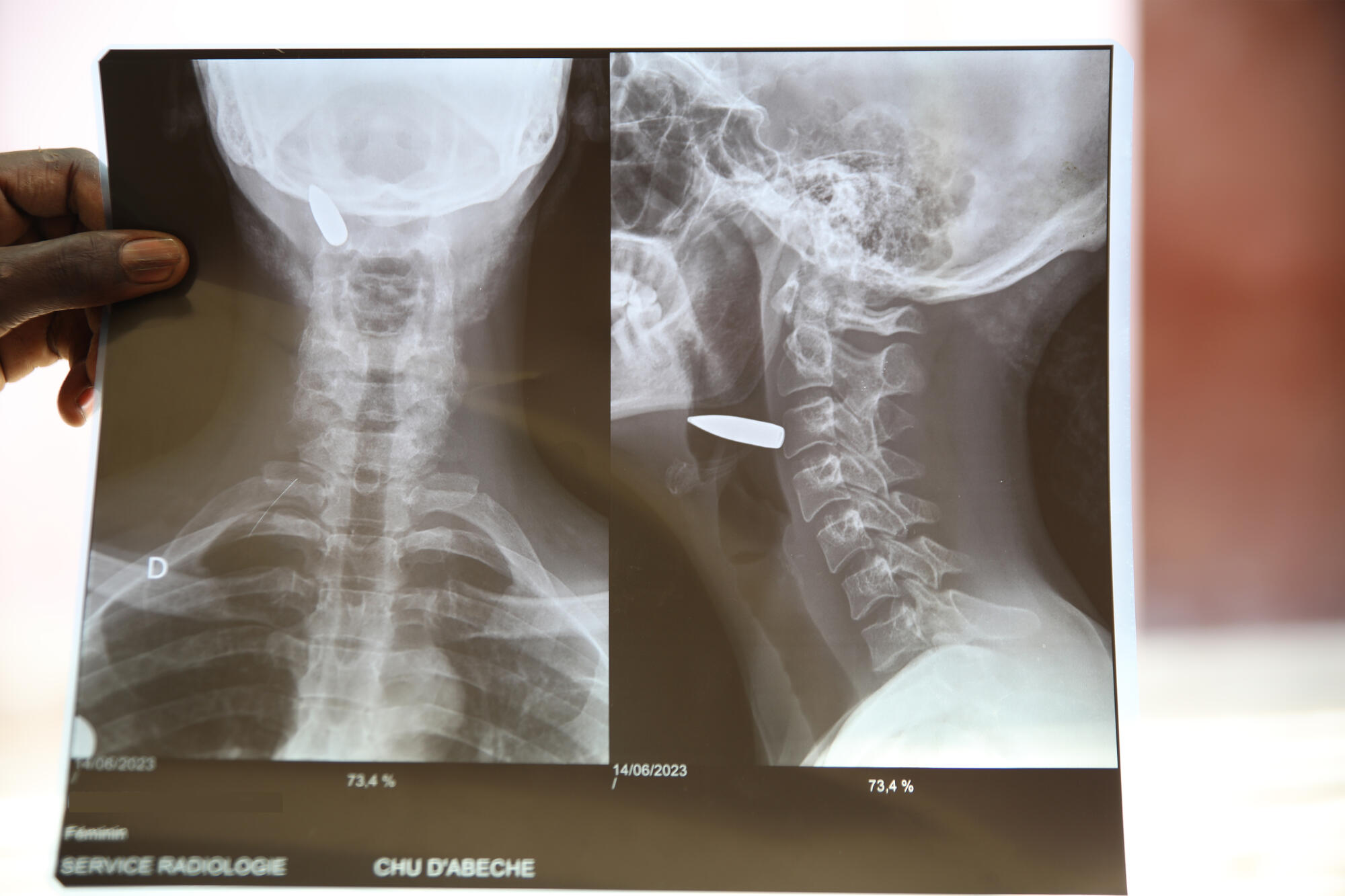 A woman shot in the neck, taken in charge in Abéché hospital - Sudan