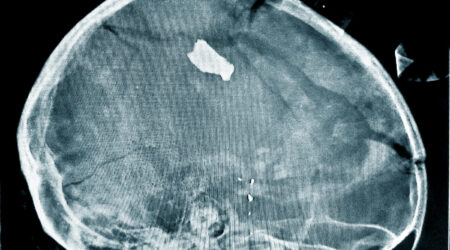 En 20 måneder gammel pige er på det lokale marked med sin mor, da en bombe eksploderer. Pigen bliver ramt af en granatsplint, som trænger gennem hendes kranie. Da lægerne forsigtigt overfører hende til røntgenscannerens bord, triller en del af hjerneskallen ud og lander på bordet.