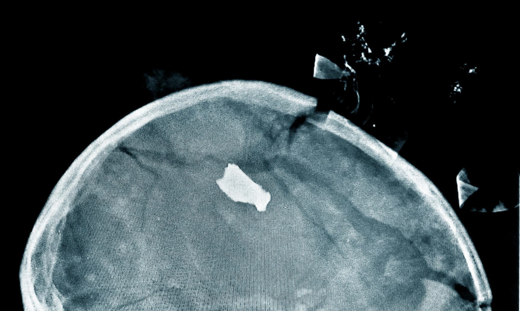 En 20 måneder gammel pige er på det lokale marked med sin mor, da en bombe eksploderer. Pigen bliver ramt af en granatsplint, som trænger gennem hendes hjerneskal. Da lægerne forsigtigt overfører hende til røntgenscannerens bord, triller en del af hjerneskallen ud og lander på bordet.