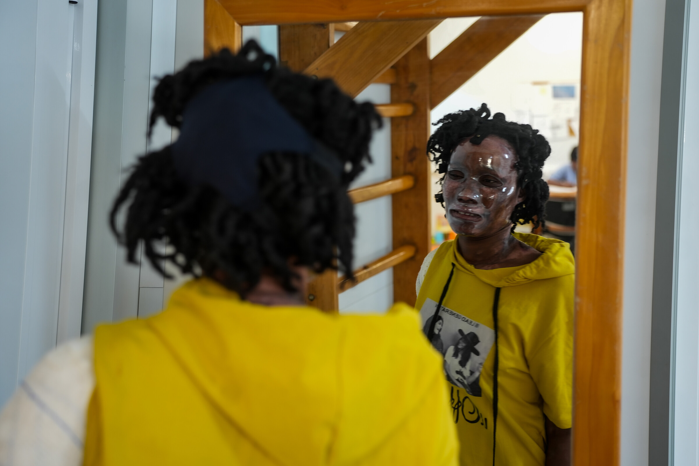 Januar. Haiti. 27-årige Marie Harolde blev alvorligt forbrændt i ansigtet, da en gasflaske eksploderede i hendes hjem. Hun blev behandlet på vores hospital i Tabarre i Port-au-Prince, hvor hun blandt andet fik en kompressionsmaske, der mindsker dannelsen af ar.  